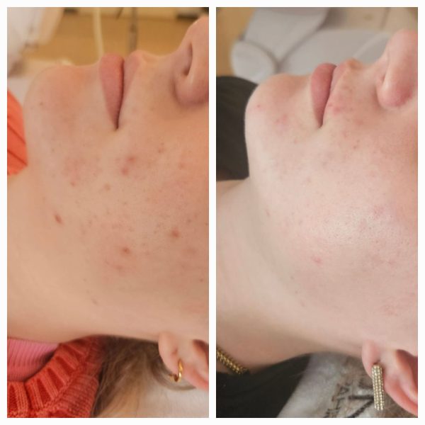 Acne_photo_example